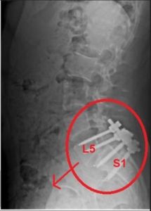 Luigi-mangione-spondilolistesi-osteopata-segrate